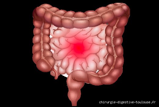Une lésion intestinale est-elle grave ? Ce que le silence de vos organes cache réellement sur votre santé