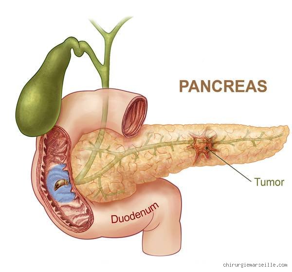 Une tumeur du pancréas de 3 cm est-elle grosse ? Pourquoi ce chiffre fait basculer le pronostic médical
