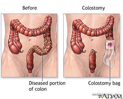What happens to your bum when you have a stoma? Le guide sans tabou sur l'avenir de votre rectum après la stomie