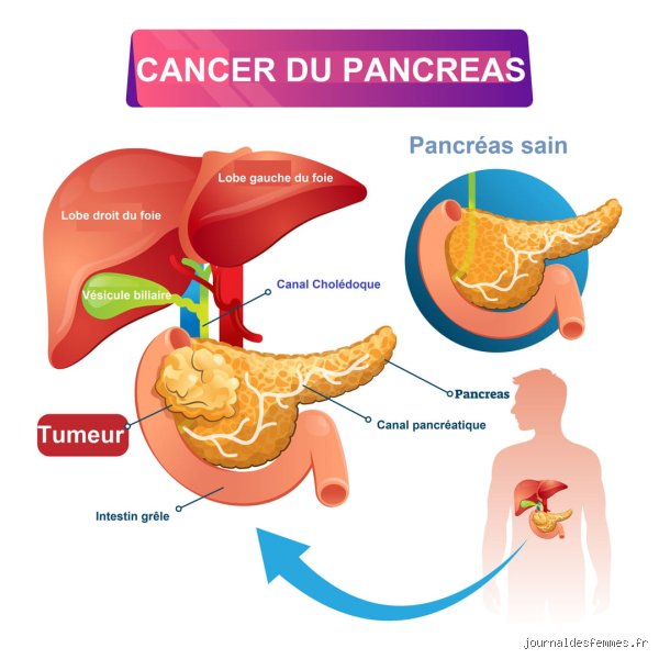 À quel stade le cancer du pancréas s'est-il propagé au foie : comprendre la bascule vers le stade 4 métastatique