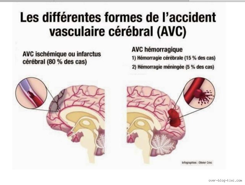 C'est quoi un AVC foudroyant ?