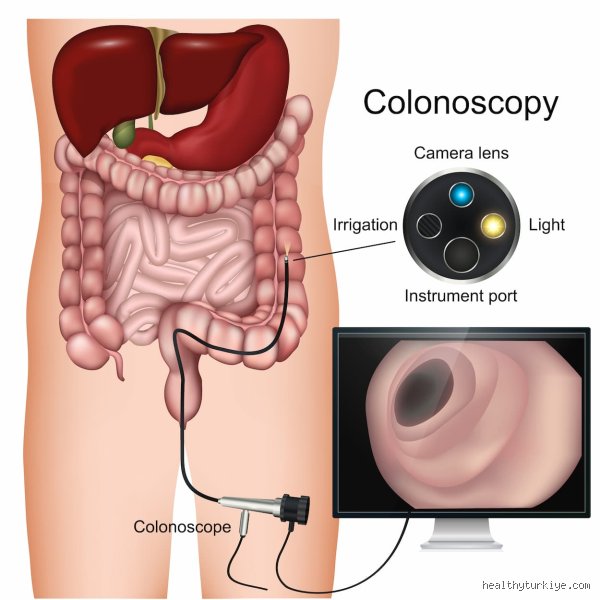 Combien de temps faut-il pour vider complètement ses intestins en vue d'une coloscopie : le guide vérité sur cette épreuve de patience