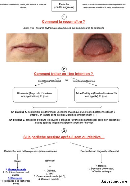 Comment attraper la perlèche (et surtout, comment s'en débarrasser !)