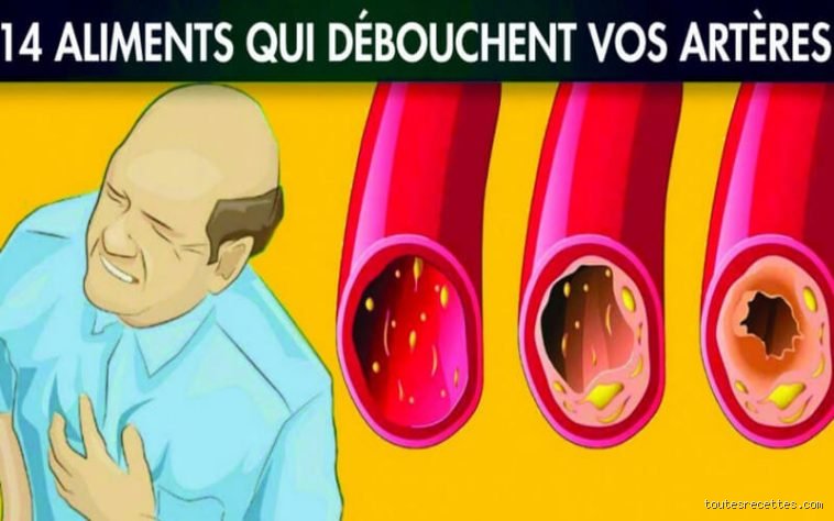 Comment enlever le calcaire dans les artères ?