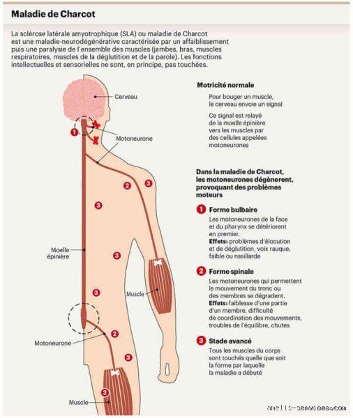 Comment ne pas attraper la maladie de Charcot ?