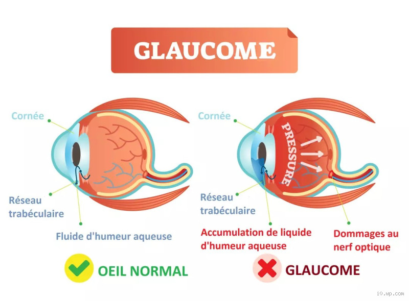 Comment on attrape un glaucome ? Les causes et facteurs de risque