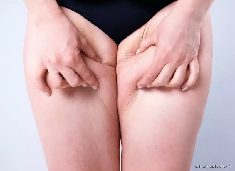 Comment retendre la peau des cuisses à 60 ans ?