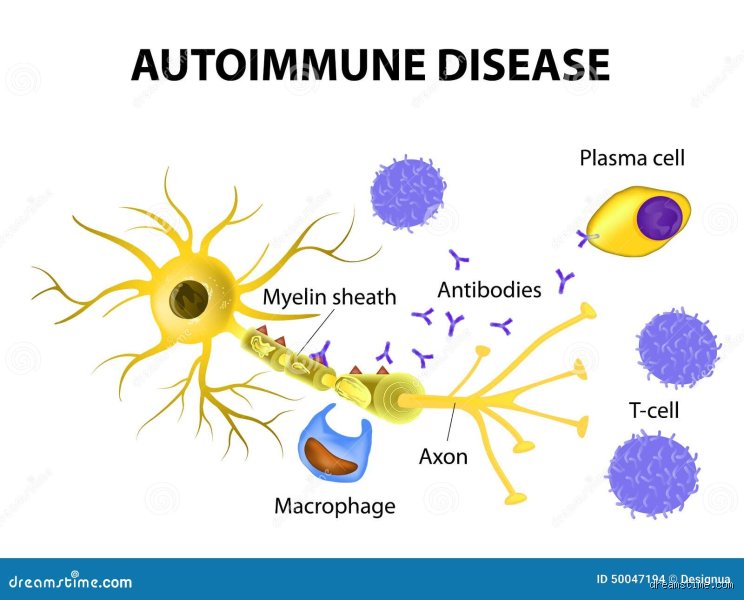 Quel est le nom de cette maladie auto-immune rare qui attaque le système nerveux périphérique ?