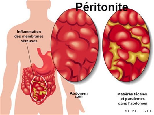 Comment savoir si j'ai une péritonite ?