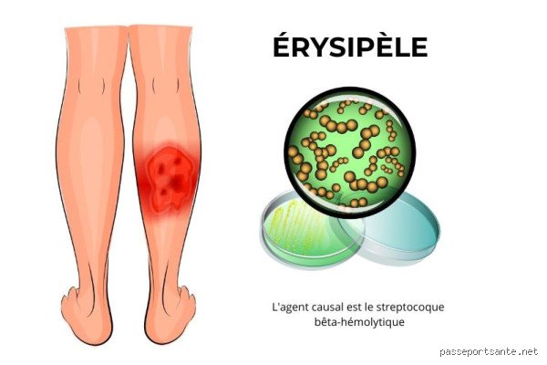 Comment se débarrasser d'un érysipèle ?