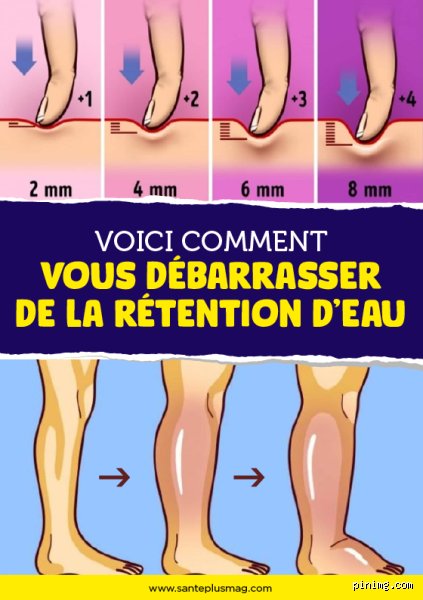 Comment se débarrasser de la rétention d'eau dans les jambes ?