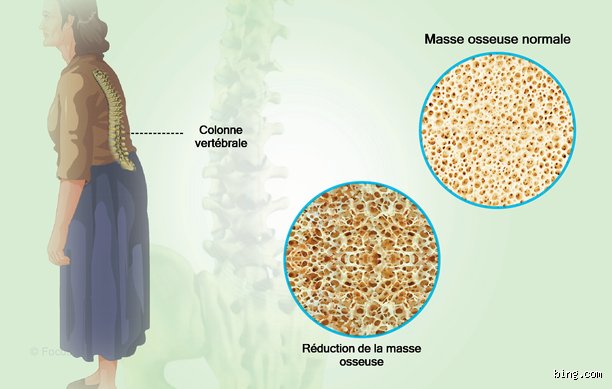 Comment soigner l'ostéoporose sans bisphosphonates ?