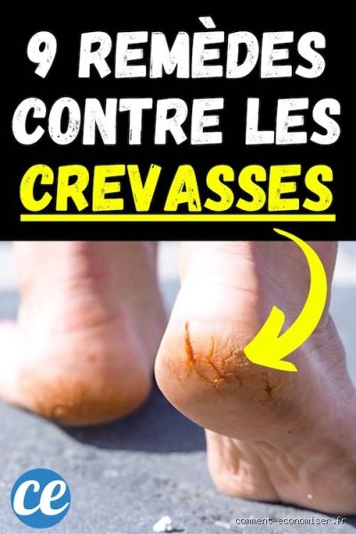 Comment soigner les crevasses rapidement ? Mon expérience et mes astuces