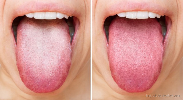 Est-ce dangereux d'avoir la langue blanche ? Découvrez les causes et solutions