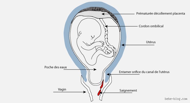 Chute et fausse couche : Le lien que vous redoutez est-il réellement si direct ?