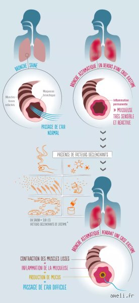 Est-ce que l'asthme est une maladie inflammatoire ?