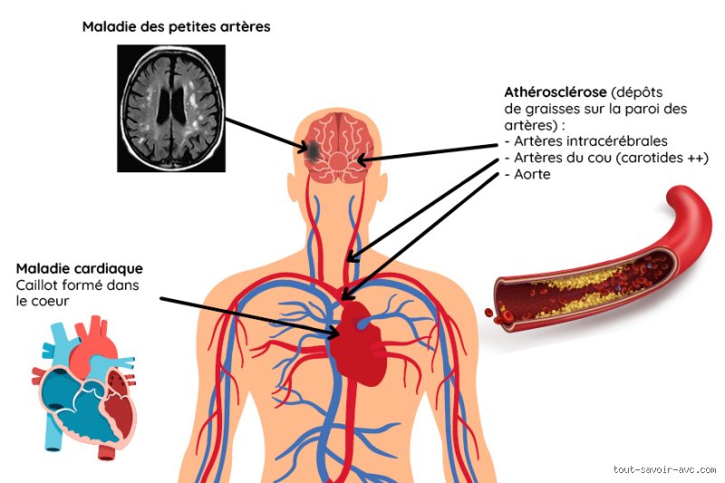 Hypotension et AVC : Existe-t-il un réel danger ?