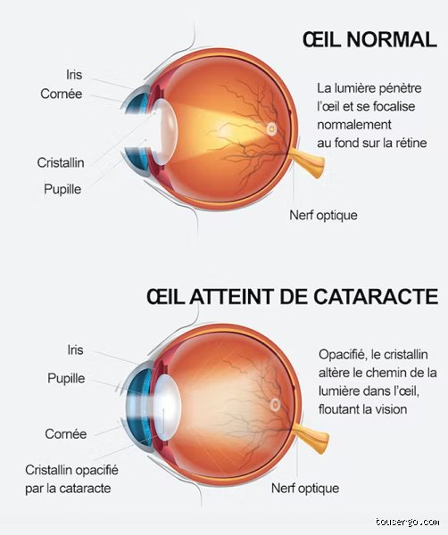 La cataracte fait-elle baisser la vue ? Tout ce qu'il faut savoir