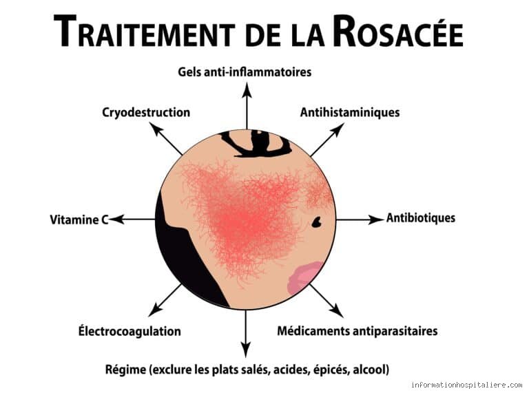 Est-ce que la rosacée se soigne ?