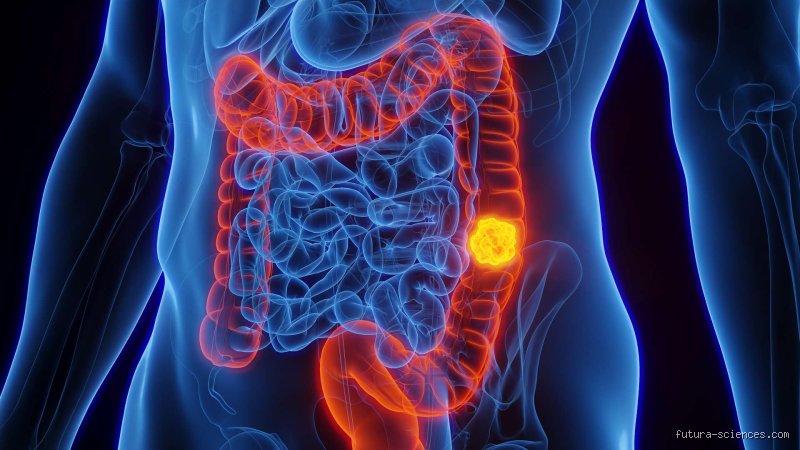 Est-ce que le cancer du côlon est mortel ?