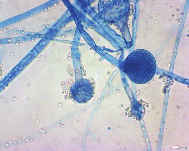 Est-ce que le diabète peut donner des mycoses ? La vérité sans filtre sur ce lien invisible mais redoutable