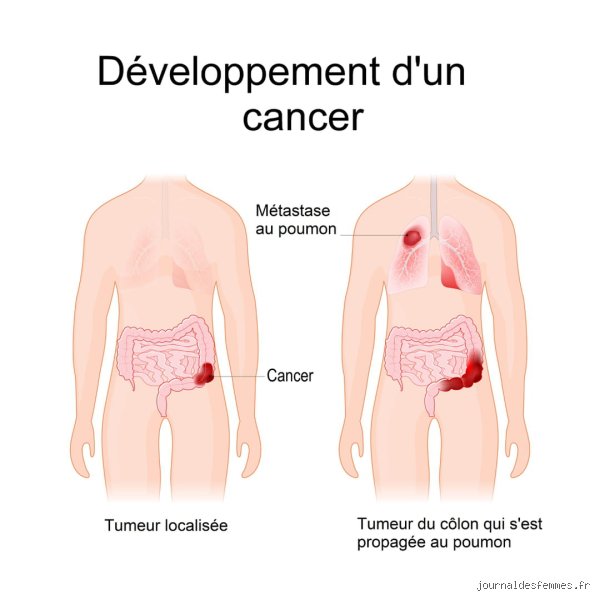 Est-ce que les métastases pulmonaires font tousser quand on cherche à comprendre les symptômes respiratoires ?
