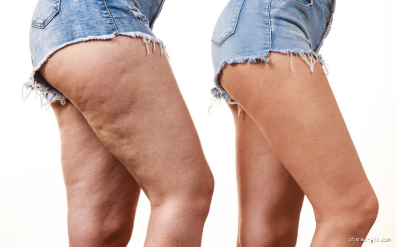 Est-ce que marcher enlève la cellulite ? La vérité sur cette méthode douce
