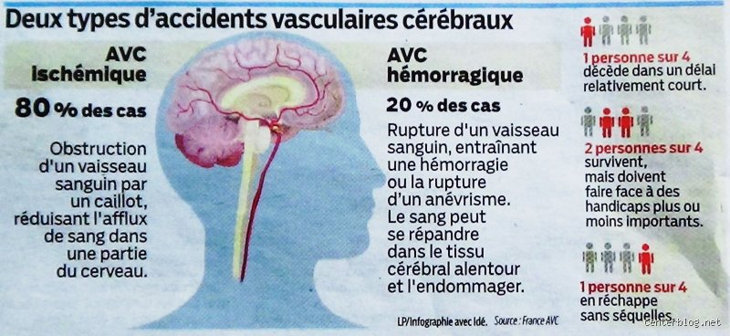 Est-ce que tout le monde peut faire un AVC ? La réalité brutale derrière le risque universel