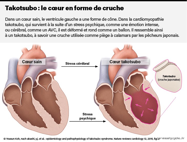 La technique du cœur explosif est-elle réelle ou n'est-ce qu'une pure fantaisie cinématographique issue de la pop culture ?