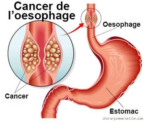 Le cancer de l'œsophage est-il grave ? Comprendre les enjeux réels, les statistiques de survie et les défis d'un diagnostic souvent tardif