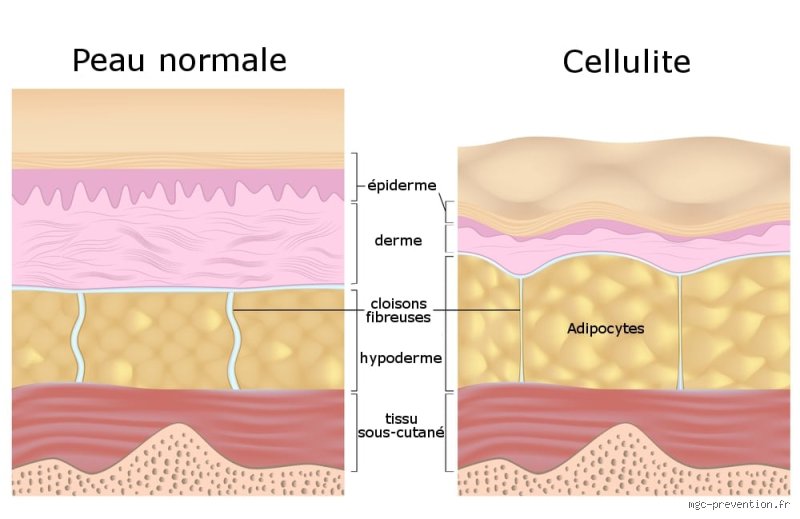 Pourquoi la cellulite ne part pas ?