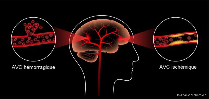 Pourquoi le stress favorise les AVC ?