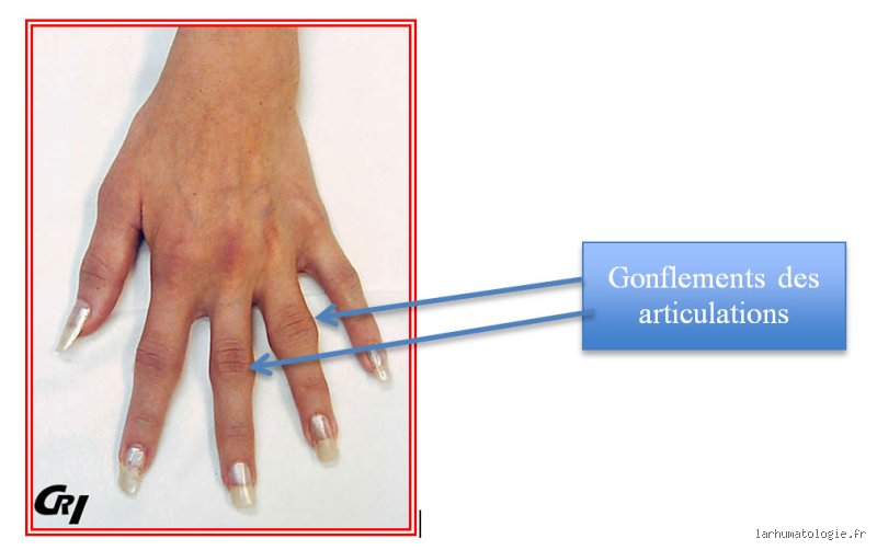 Pourquoi mes articulations des doigts grossissent : Démêler le vrai du mythe de l'arthrose