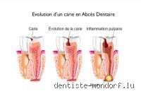Pourquoi un abcès dentaire revient-il ?