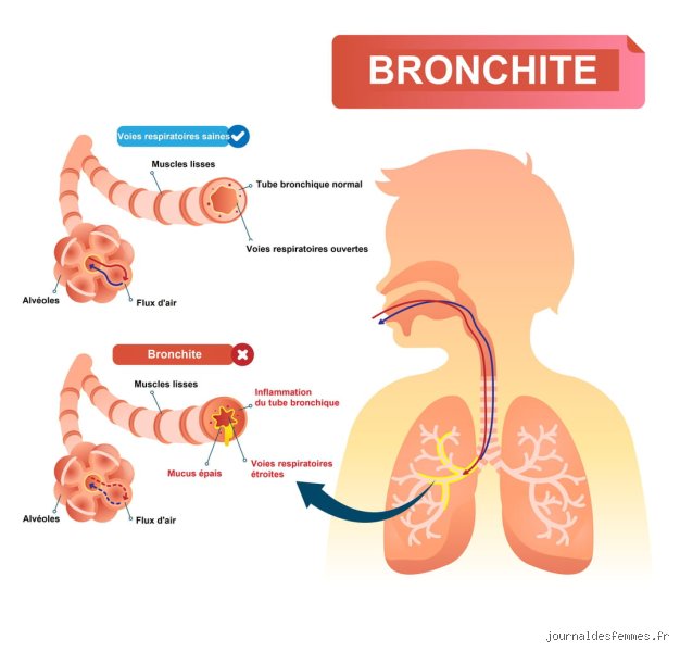 Puis-je sortir avec une bronchite ?