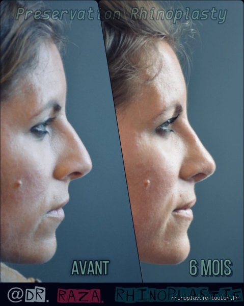 Quand on vieillit le nez grossit-il vraiment ?