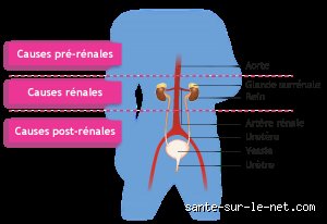 Quand parle-t-on anurie ? Définition, seuils critiques et urgence médicale