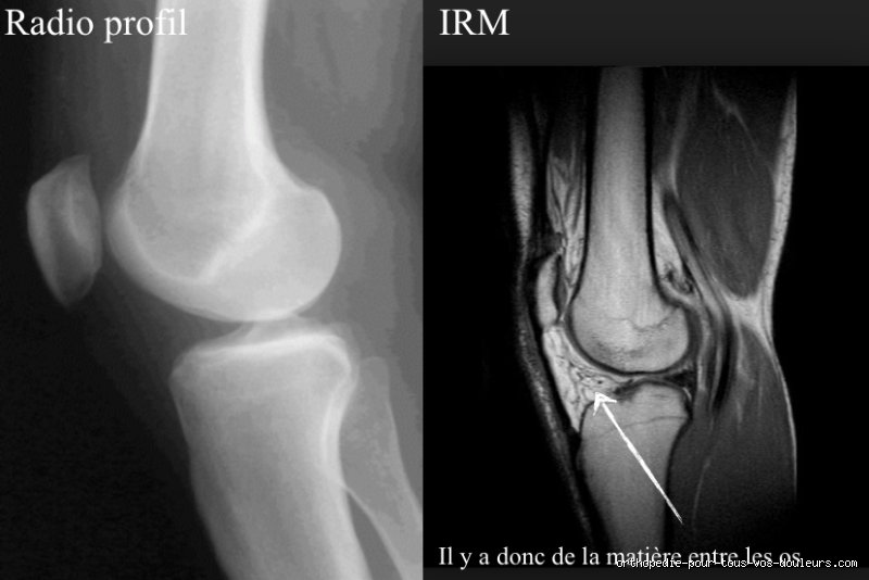 Que se passera-t-il si l'arthrose n'est pas traitée ? Les risques d'une dégradation silencieuse