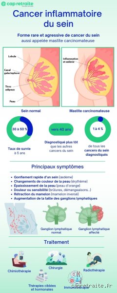 Quel cancer provoque une inflammation ? Les liaisons dangereuses décryptées par la science