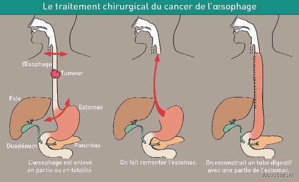 Quel type de chimio pour un cancer de l'œsophage ? Comprendre les protocoles de pointe et les stratégies thérapeutiques actuelles