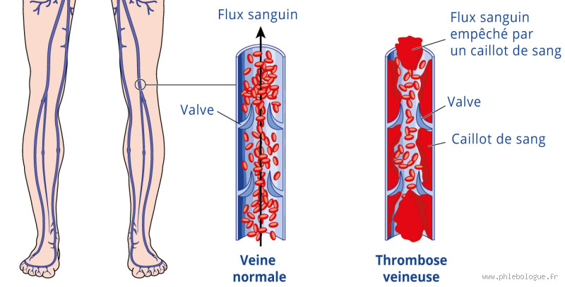 Quelle est la différence entre une thrombose et une phlébite ?