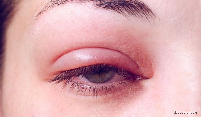 Quelle maladie fait gonfler les yeux ? Décrypter les causes de cet œdème souvent trompeur