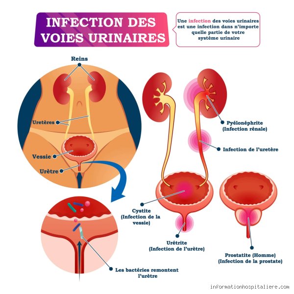 Quelle maladie fait uriner beaucoup chez la femme ?