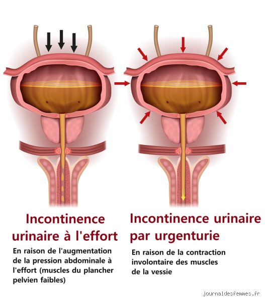 Les Causes des Fuites Urinaires chez la Femme : Une Exploration Approfondie