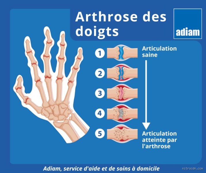 Pourquoi vos doigts vous font-ils souffrir par crises ? Comprendre les vraies causes des poussées d'arthrose