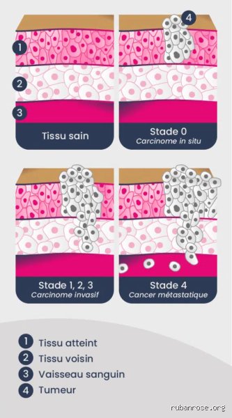 Quels sont les 3 principaux diagnostics de cancer et la réalité clinique d'une médecine sous haute tension