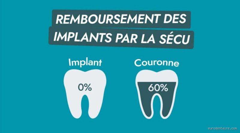 Quels sont les prothèses dentaires remboursées par la sécurité sociale ?