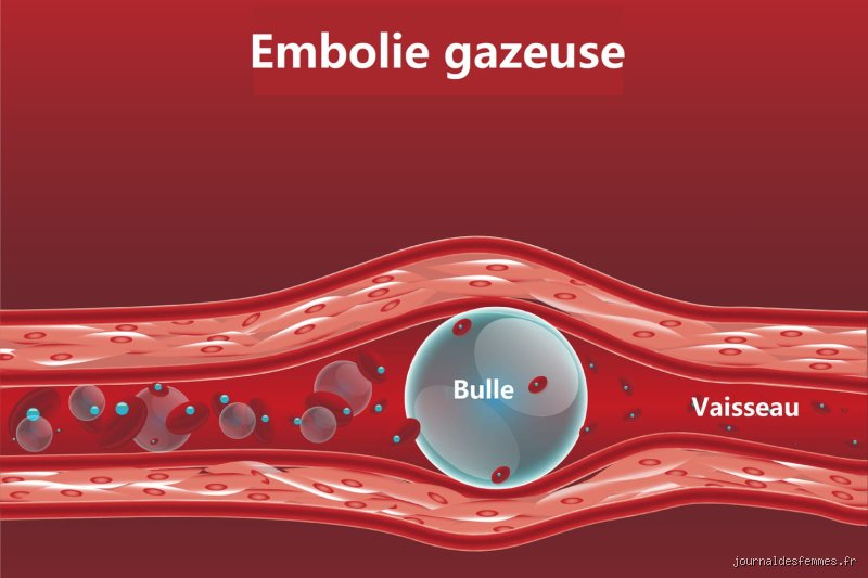 Quels sont les signes d'une embolie gazeuse ?