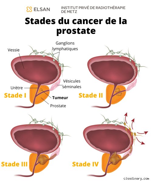 Qui favorise le cancer de la prostate ? Les facteurs de risque à connaître