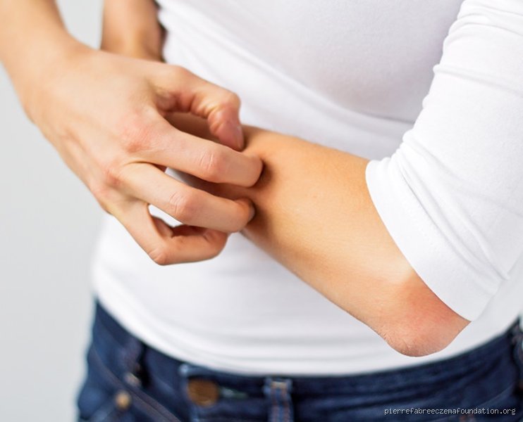 Comment ne plus gratter son eczéma ?